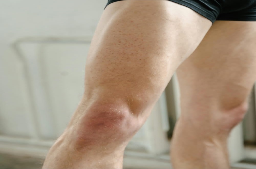 Osteoarthritis (OA) Rehabilitation